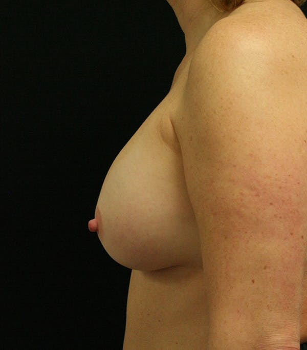 Breast Augmentation Before & After Gallery - Patient 146247823 - Image 6