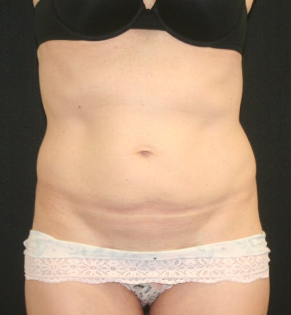 Tummy Tuck Before & After Gallery - Patient 147104133 - Image 1