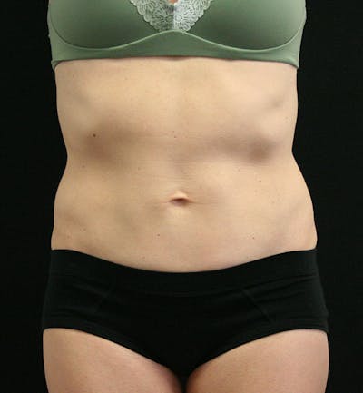 Tummy Tuck Before & After Gallery - Patient 147104133 - Image 2