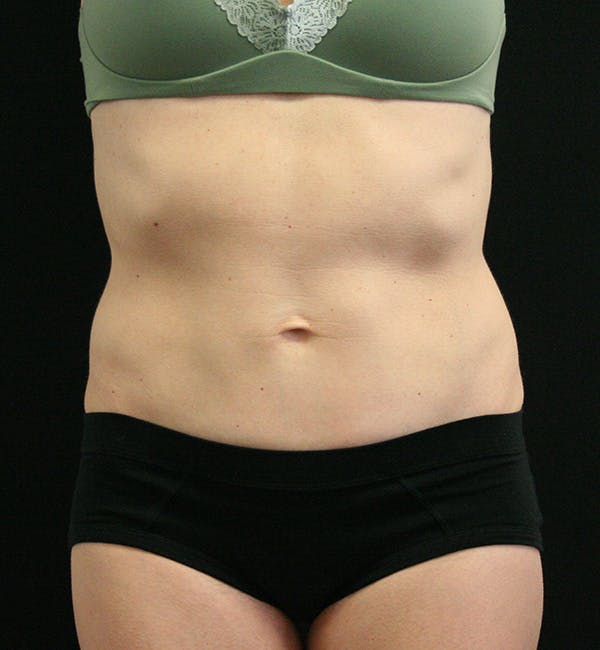 Tummy Tuck Before & After Gallery - Patient 147104133 - Image 2