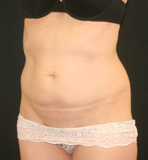 Tummy Tuck Before & After Gallery - Patient 147104133 - Image 3