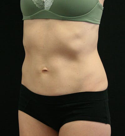 Tummy Tuck Before & After Gallery - Patient 147104133 - Image 4