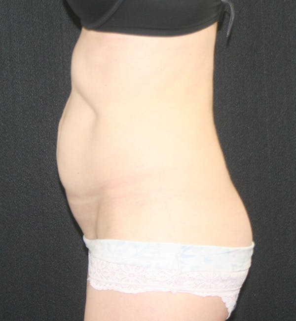 Tummy Tuck Before & After Gallery - Patient 147104133 - Image 5