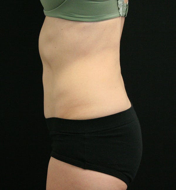Tummy Tuck Before & After Gallery - Patient 147104133 - Image 6