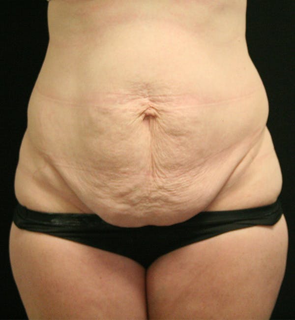 Tummy Tuck Before & After Gallery - Patient 147390750 - Image 1