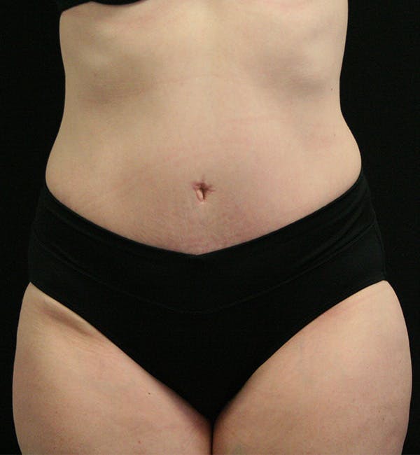 Tummy Tuck Before & After Gallery - Patient 147390750 - Image 2