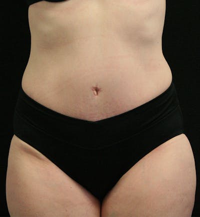 Tummy Tuck Before & After Gallery - Patient 147390750 - Image 2