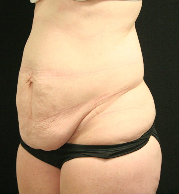 Tummy Tuck Before & After Gallery - Patient 147390750 - Image 3