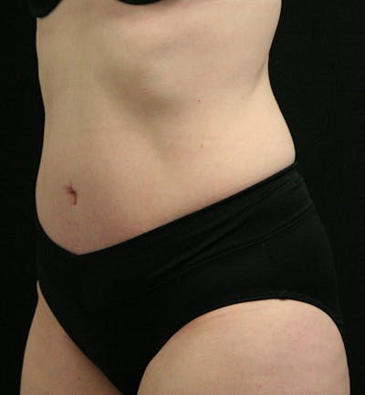 Tummy Tuck Before & After Gallery - Patient 147390750 - Image 4