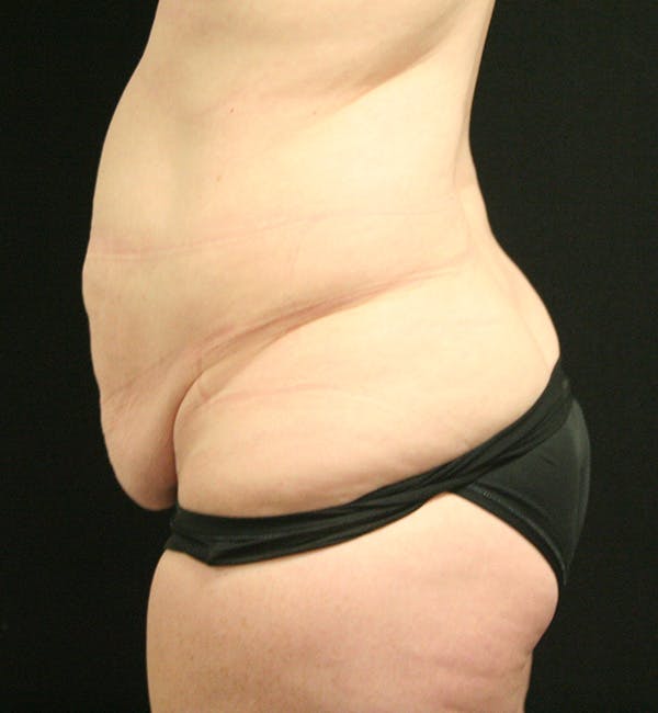 Tummy Tuck Before & After Gallery - Patient 147390750 - Image 5