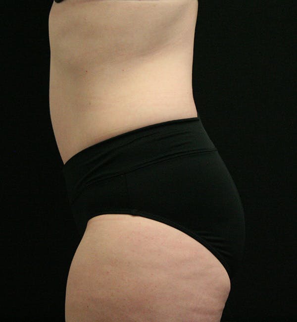 Tummy Tuck Before & After Gallery - Patient 147390750 - Image 6