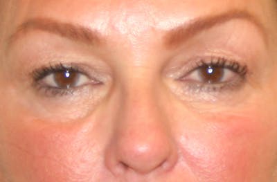 Eye Lift Before & After Gallery - Patient 147519194 - Image 1