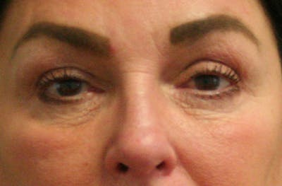 Eye Lift Before & After Gallery - Patient 147519194 - Image 2