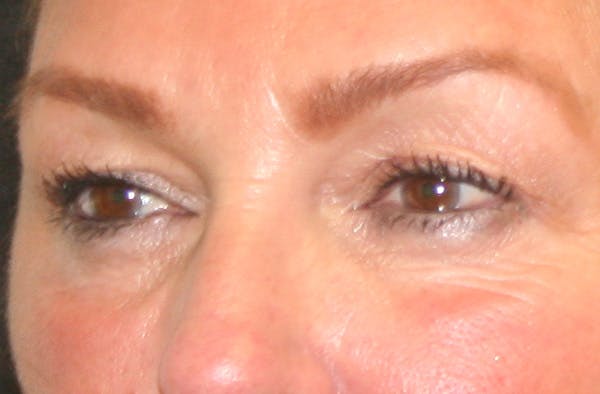 Eye Lift Before & After Gallery - Patient 147519194 - Image 3