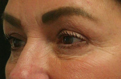 Eye Lift Before & After Gallery - Patient 147519194 - Image 4