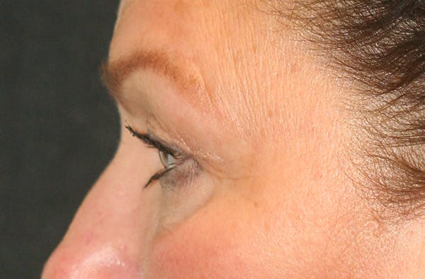 Eye Lift Before & After Gallery - Patient 147519194 - Image 5