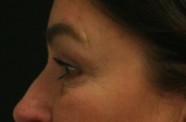 Eye Lift Before & After Gallery - Patient 147519194 - Image 6