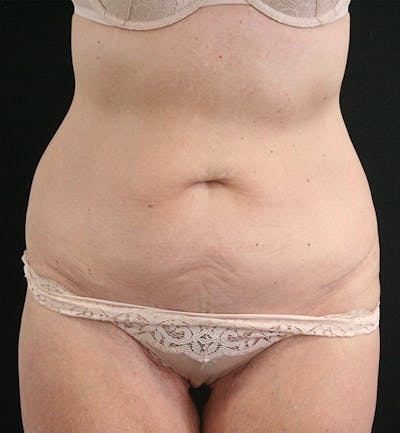 Tummy Tuck Before & After Gallery - Patient 148314065 - Image 1