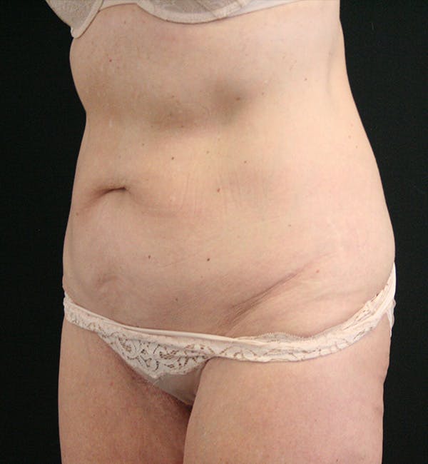 Tummy Tuck Before & After Gallery - Patient 148314065 - Image 3