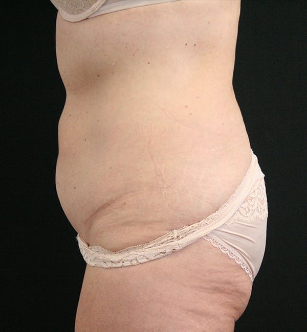 Tummy Tuck Before & After Gallery - Patient 148314065 - Image 5
