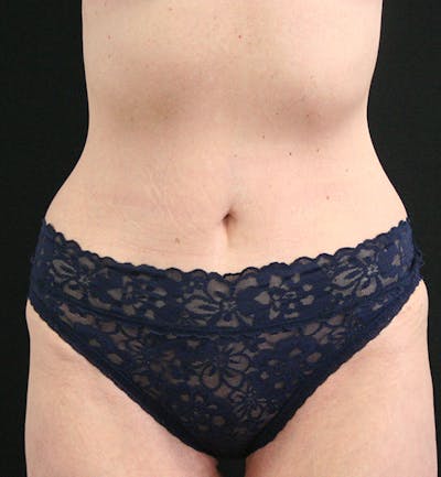 Tummy Tuck Before & After Gallery - Patient 148314065 - Image 2