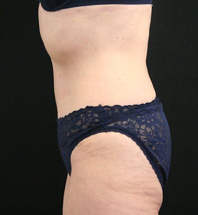 Tummy Tuck Before & After Gallery - Patient 148314065 - Image 6