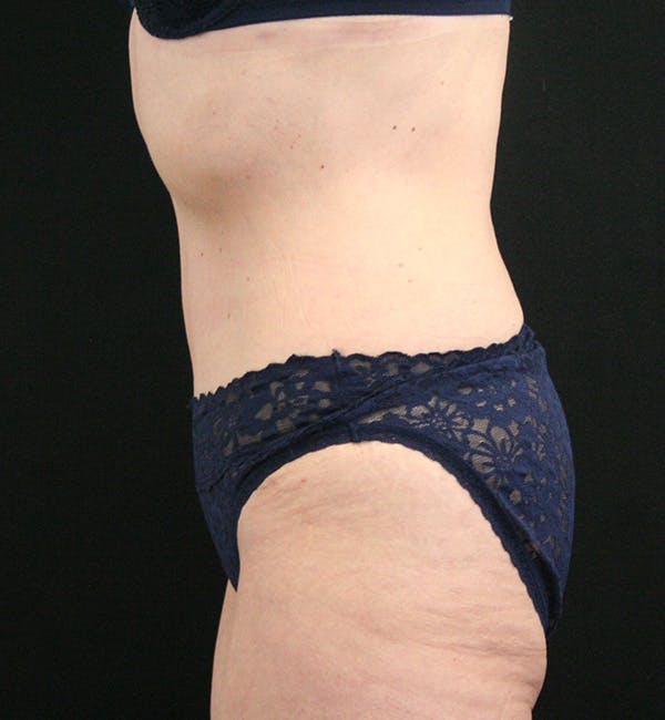 Tummy Tuck Before & After Gallery - Patient 148314065 - Image 6