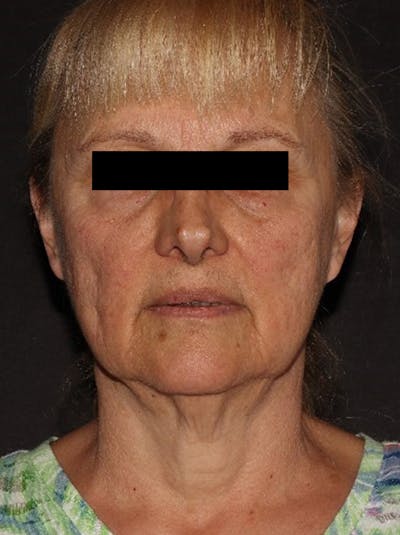 Facelift Before & After Gallery - Patient 376602 - Image 1