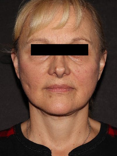 Facelift Before & After Gallery - Patient 376602 - Image 2