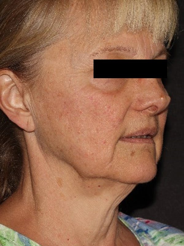 Facelift Before & After Gallery - Patient 376602 - Image 3