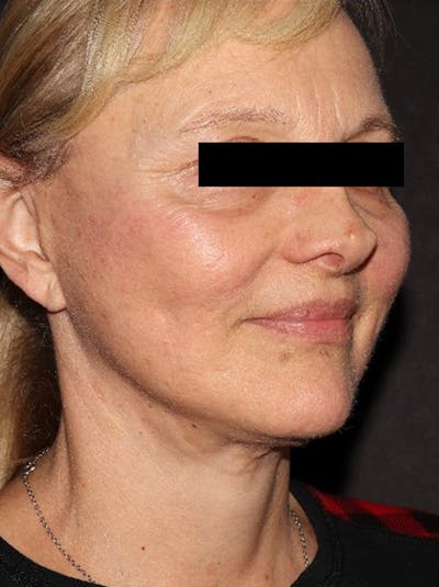 Facelift Before & After Gallery - Patient 376602 - Image 4