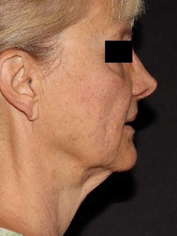 Facelift Before & After Gallery - Patient 376602 - Image 5