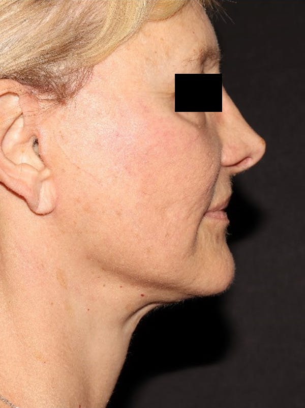 Facelift Before & After Gallery - Patient 376602 - Image 6