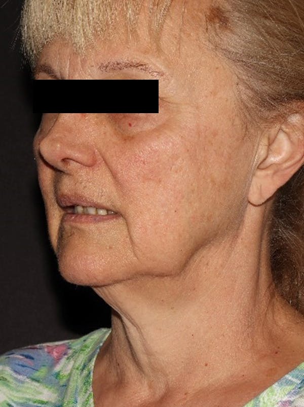 Facelift Before & After Gallery - Patient 376602 - Image 7