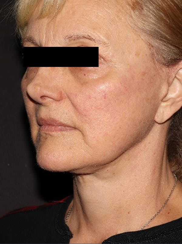 Facelift Before & After Gallery - Patient 376602 - Image 8