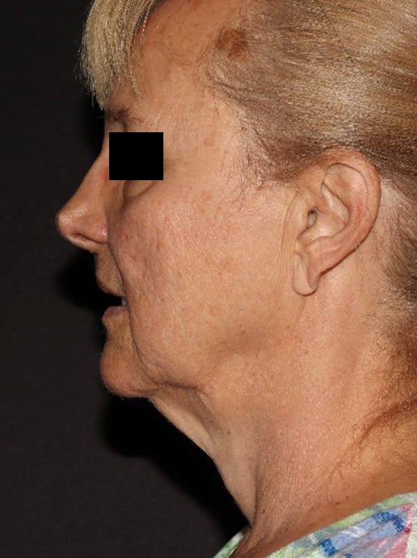 Facelift Before & After Gallery - Patient 376602 - Image 9