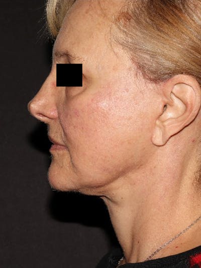 Facelift Before & After Gallery - Patient 376602 - Image 10