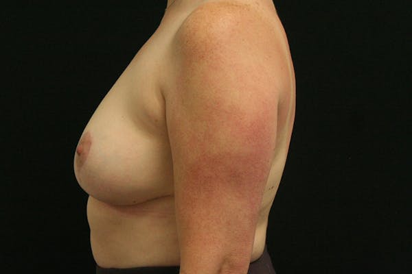 Breast Reduction Before & After Gallery - Patient 328119 - Image 6
