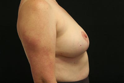 Breast Reduction Before & After Gallery - Patient 328119 - Image 10