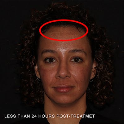 Moxi Laser Before & After Gallery - Patient 349998 - Image 2