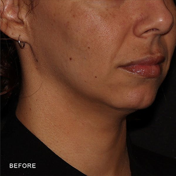 Moxi Laser Before & After Gallery - Patient 349998 - Image 3