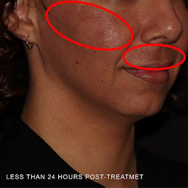 Moxi Laser Before & After Gallery - Patient 349998 - Image 4