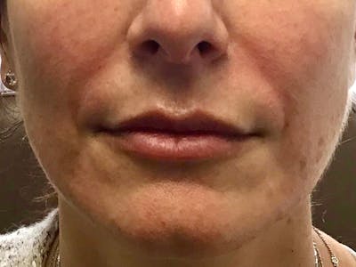Dermal Fillers Before & After Gallery - Patient 244248 - Image 2