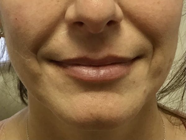 Dermal Fillers Before & After Gallery - Patient 244248 - Image 1