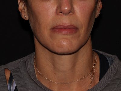 Chemical Peel Before & After Gallery - Patient 392843 - Image 1