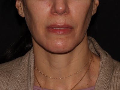 Chemical Peel Before & After Gallery - Patient 392843 - Image 2