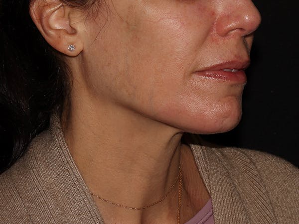 Chemical Peel Before & After Gallery - Patient 392843 - Image 3