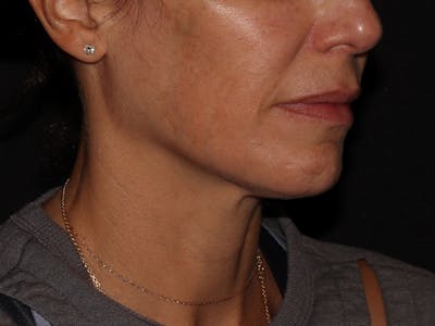 Chemical Peel Before & After Gallery - Patient 392843 - Image 4