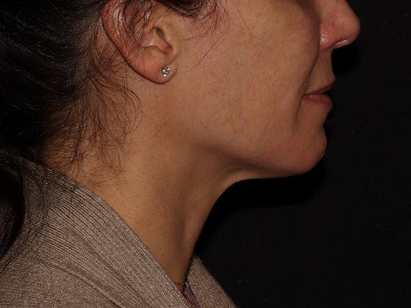 Chemical Peel Before & After Gallery - Patient 392843 - Image 5