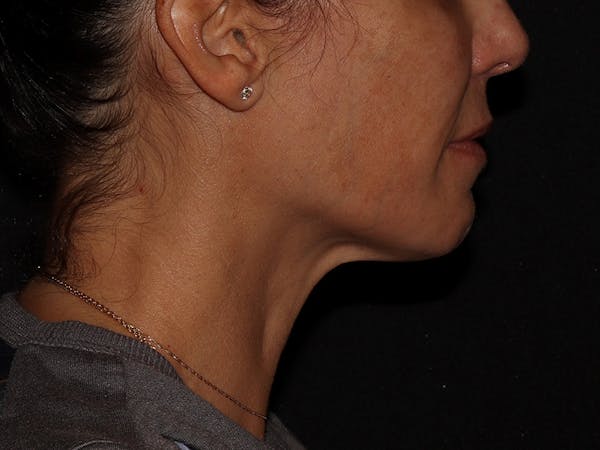 Chemical Peel Before & After Gallery - Patient 392843 - Image 6